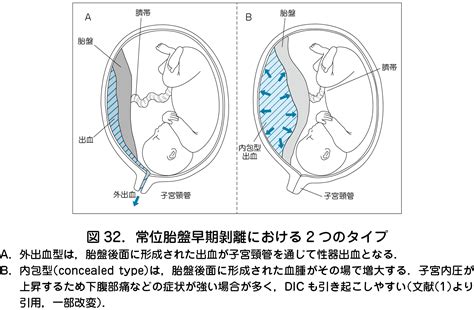 胎盤剝離後期|妊娠後期の怖い合併症：常位胎盤早期剥離って？ – 産婦人科オン。